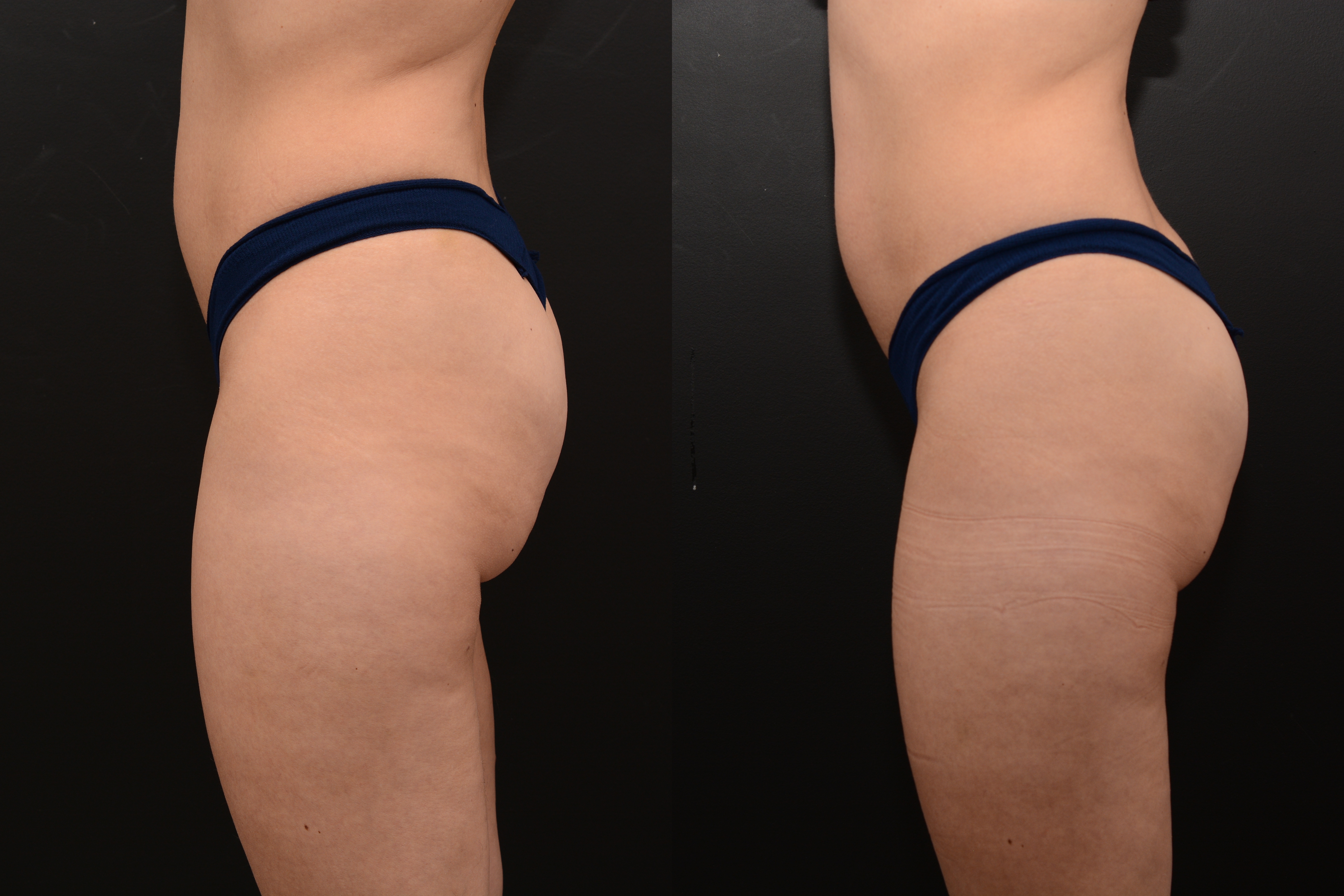 Emsculpt buttocks enhancement after 4 treatments - before and after